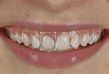 advanced-smile-design-technology:-precision-planning-for-guaranteed-results