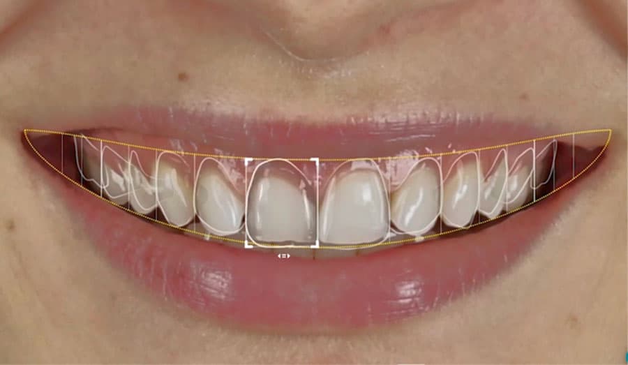 advanced-smile-design-technology:-precision-planning-for-guaranteed-results